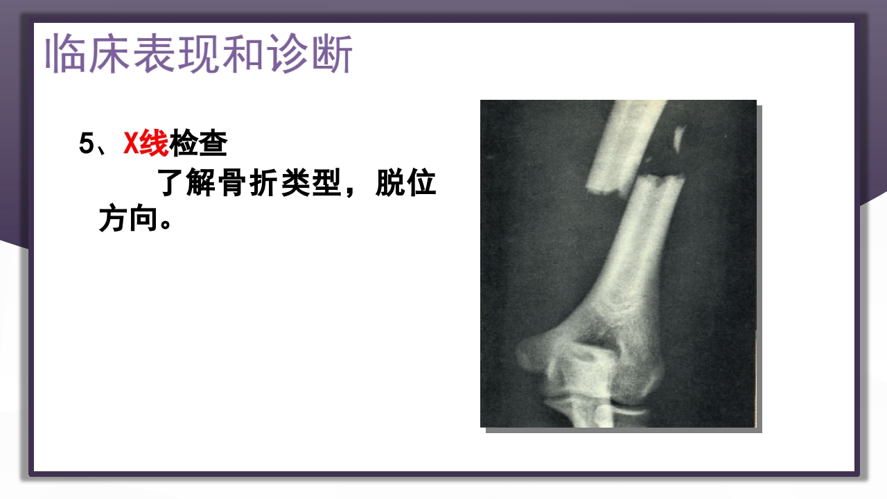 上肢骨关节损伤PPT课件31