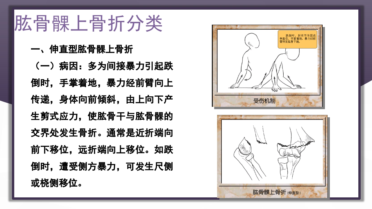 上肢骨关节损伤PPT课件49