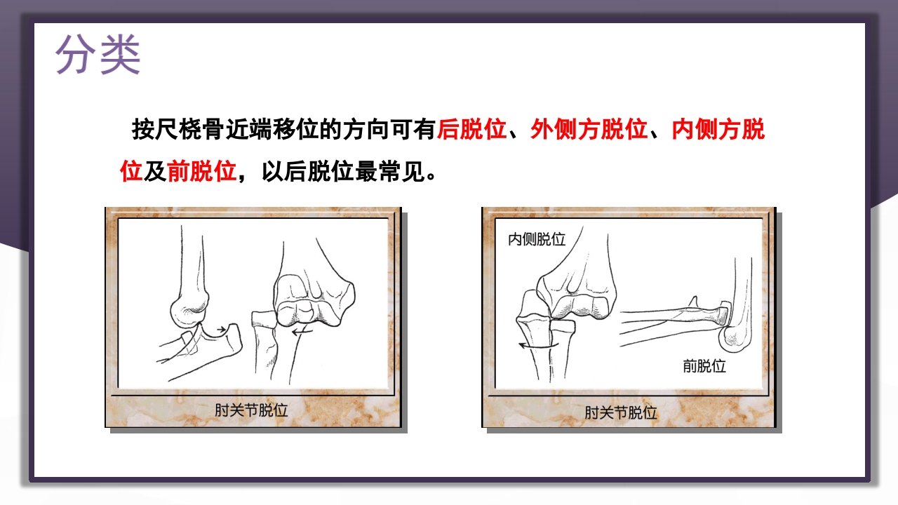 上肢骨关节损伤PPT课件58