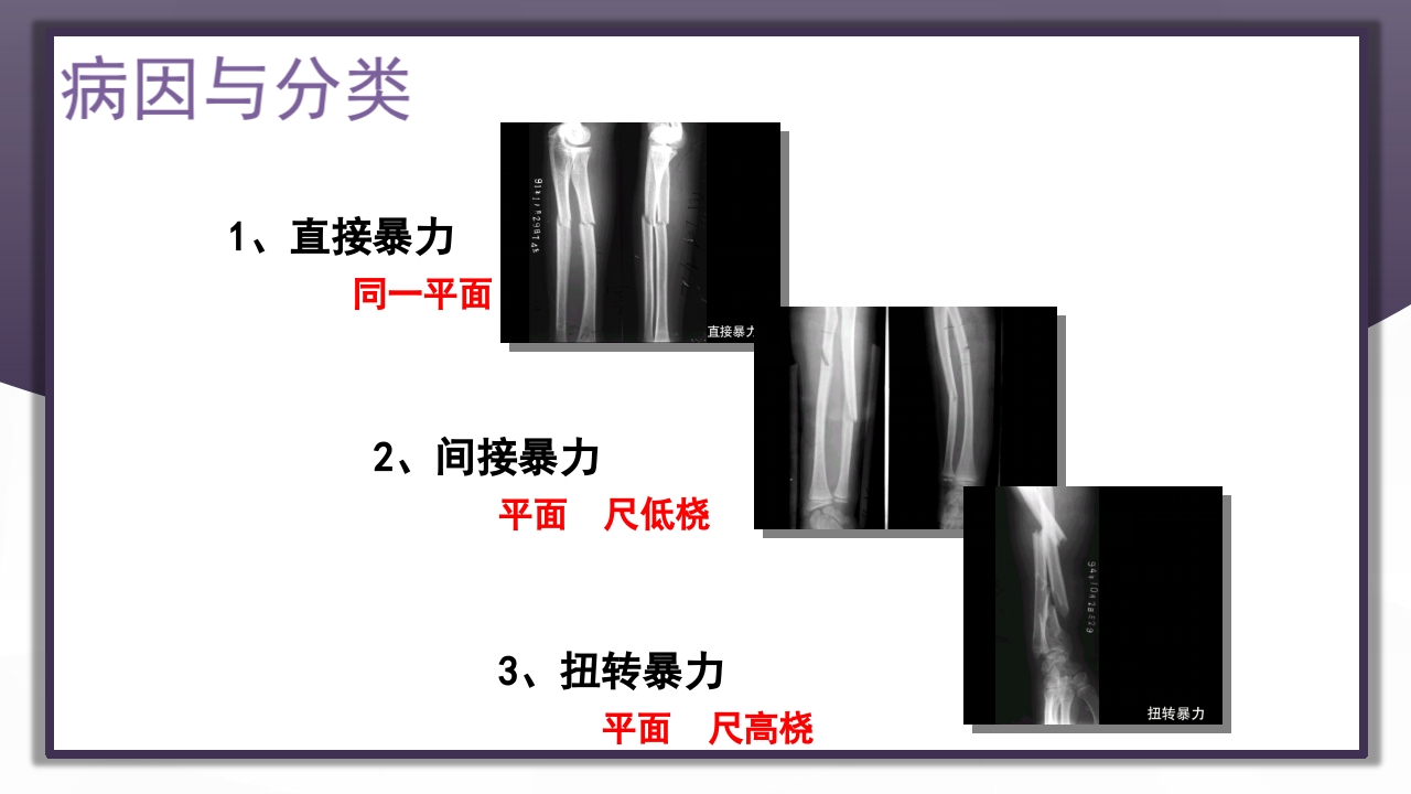 上肢骨关节损伤PPT课件65
