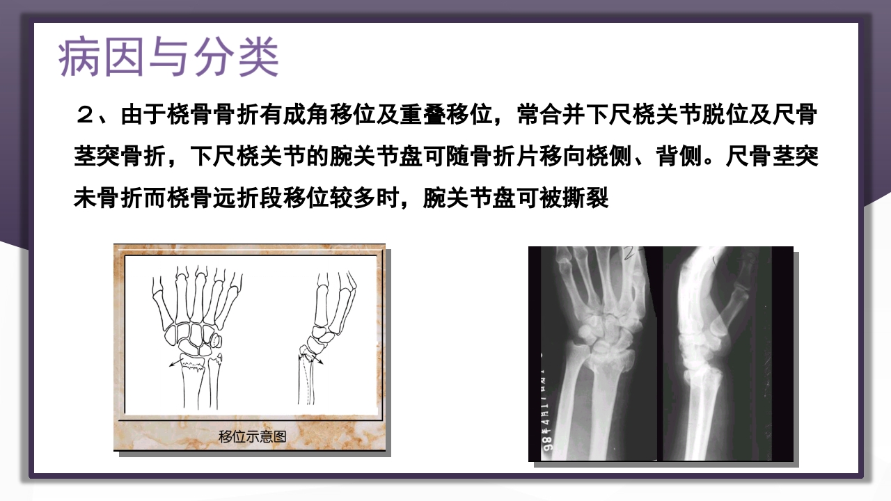 上肢骨关节损伤PPT课件71