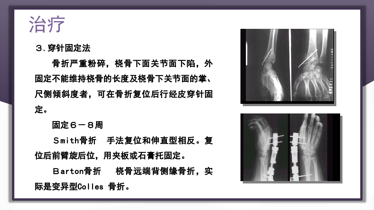 上肢骨关节损伤PPT课件76