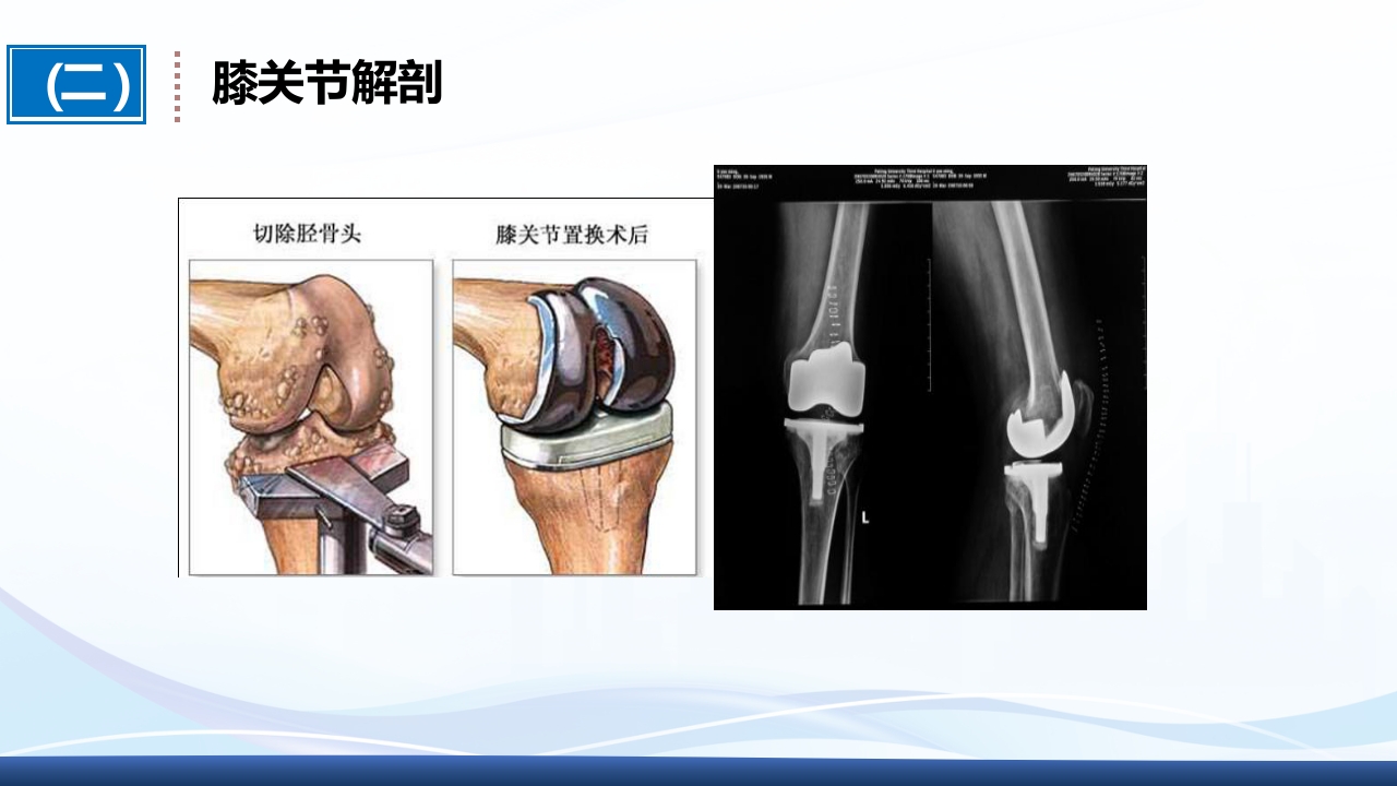 全膝关节置换术围手术期护理ppt课件7