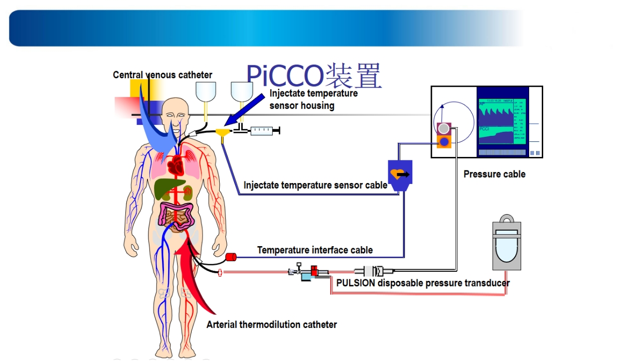 心源性休克诊治思路与进展ppt课件41