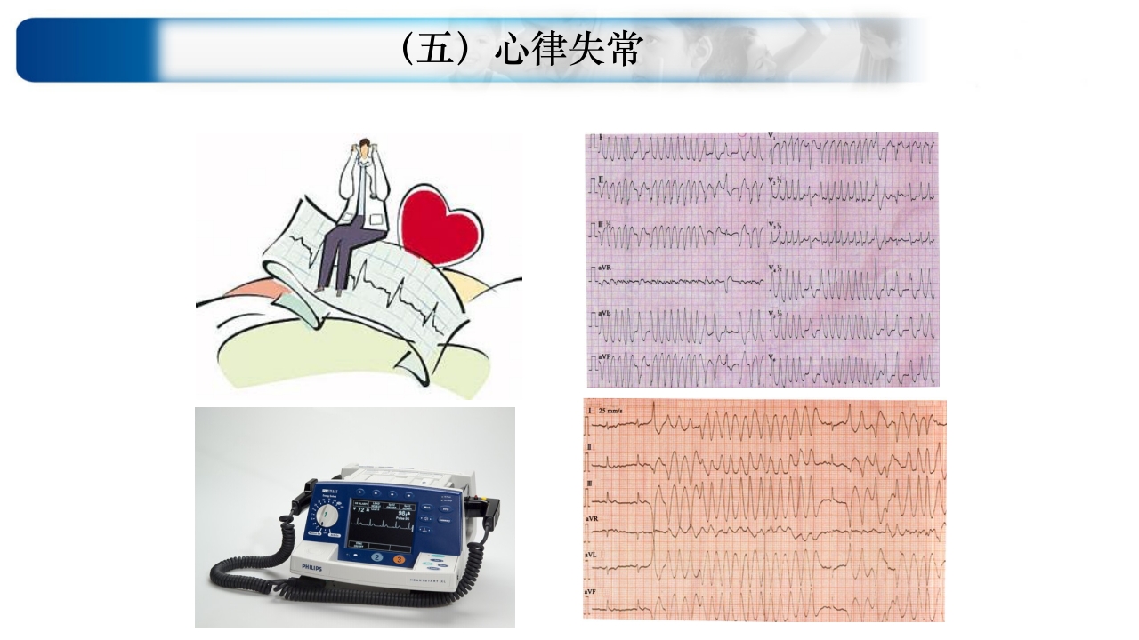 心源性休克诊治思路与进展ppt课件56