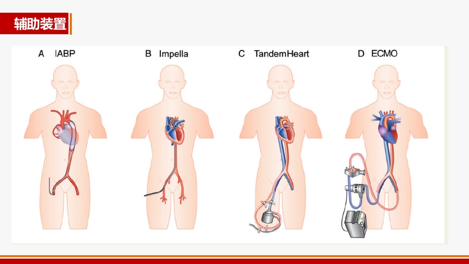 心源性休克诊治进展PPT课件37