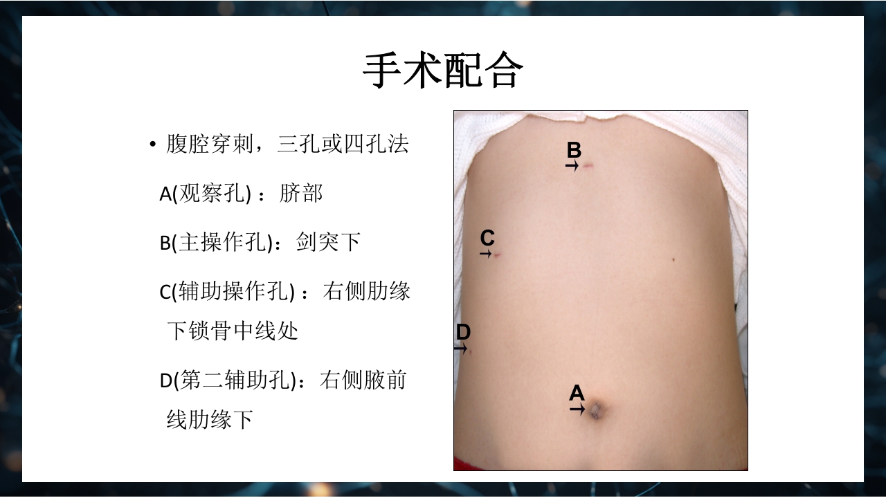 腹腔镜下胆囊切除术手术配合PPT课件13