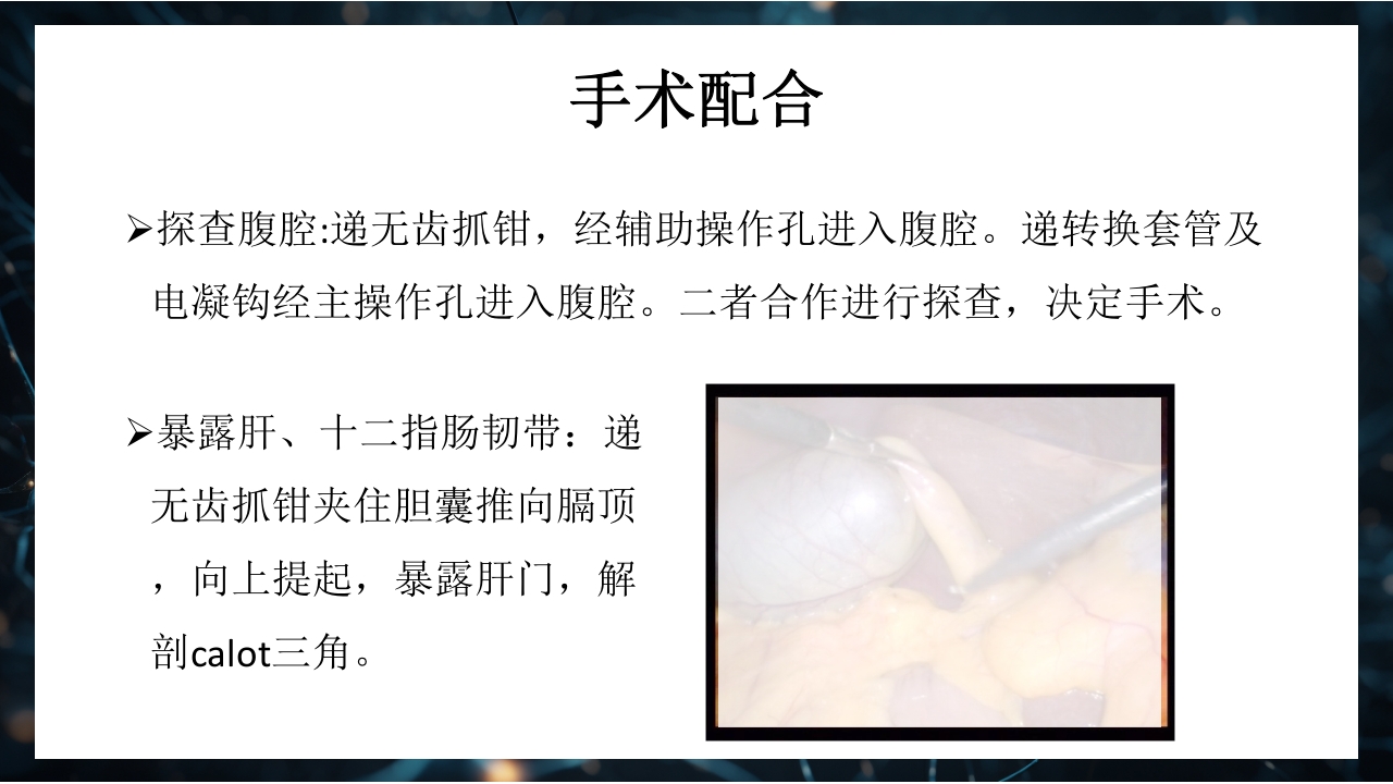 腹腔镜下胆囊切除术手术配合PPT课件14