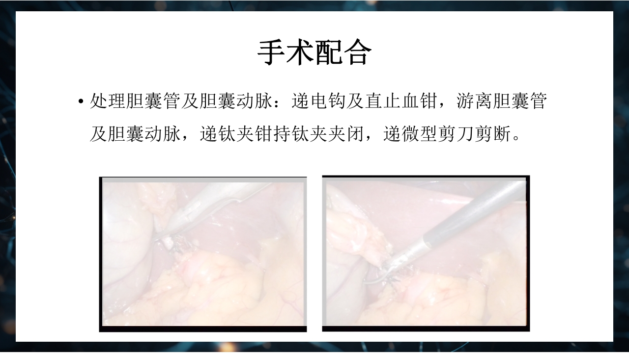 腹腔镜下胆囊切除术手术配合PPT课件15