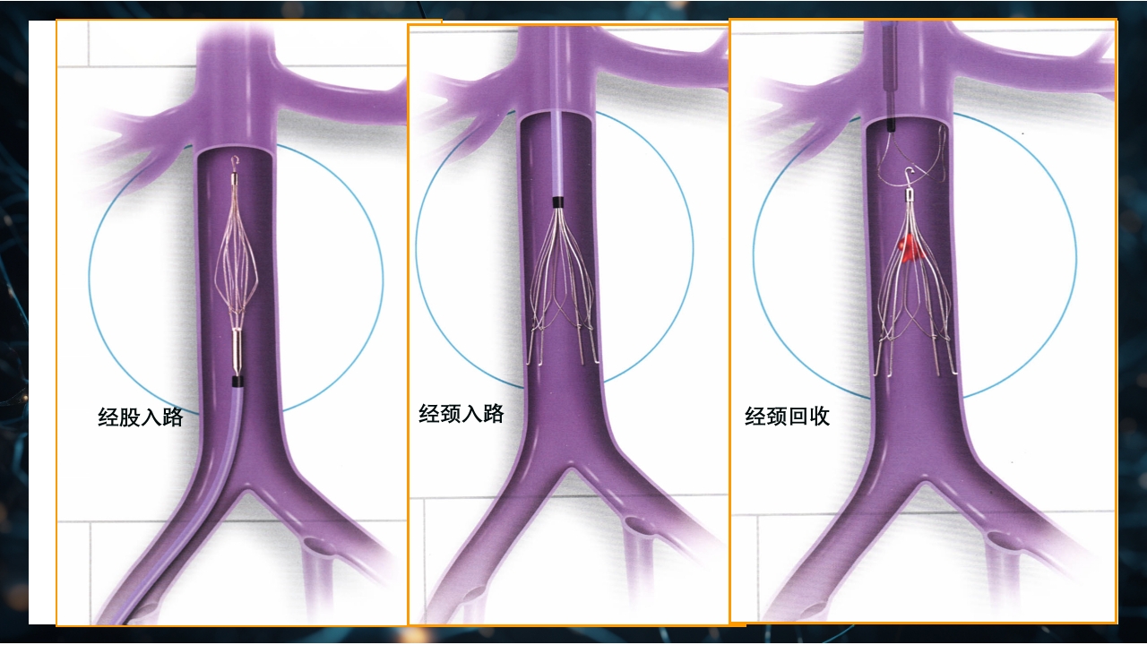 下肢深静脉血栓防治指南PPT课件16