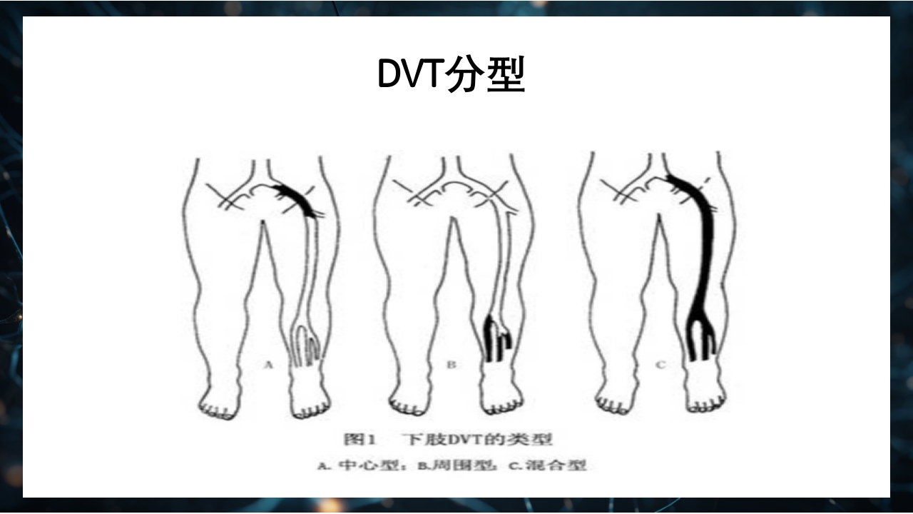 下肢深静脉血栓防治指南PPT课件6