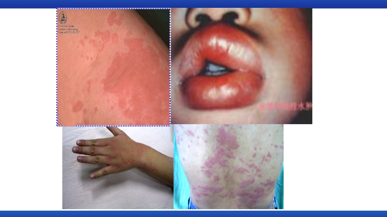 过敏性休克的识别及处理流程PPT课件12