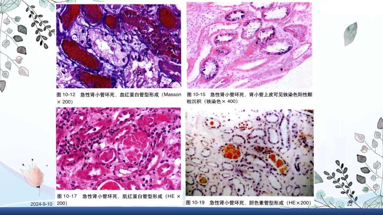 急性肾衰竭PPT课件22