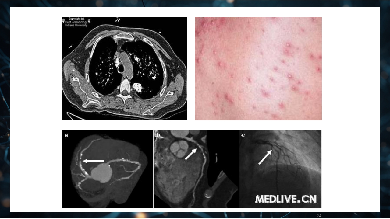 慢性肾衰竭PPT课件24