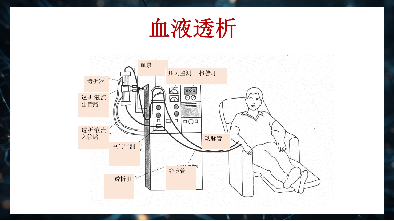 慢性肾衰竭PPT课件38