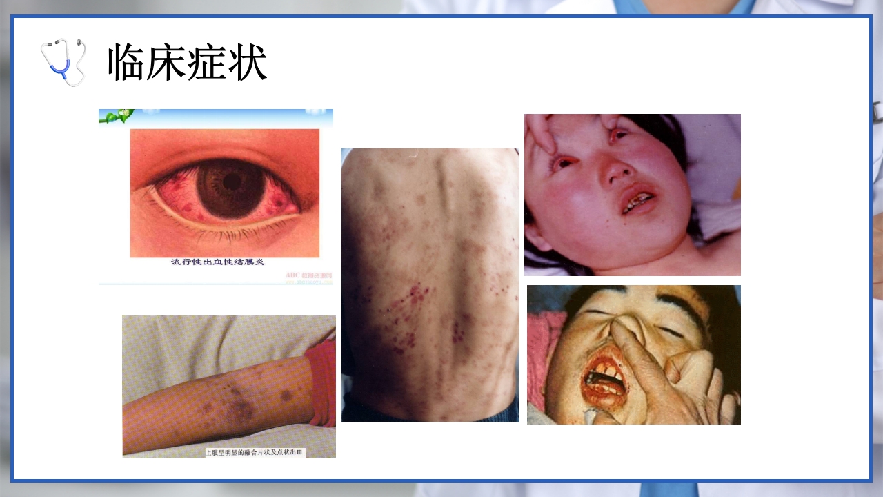 流行性出血热的个案护理PPT课件6