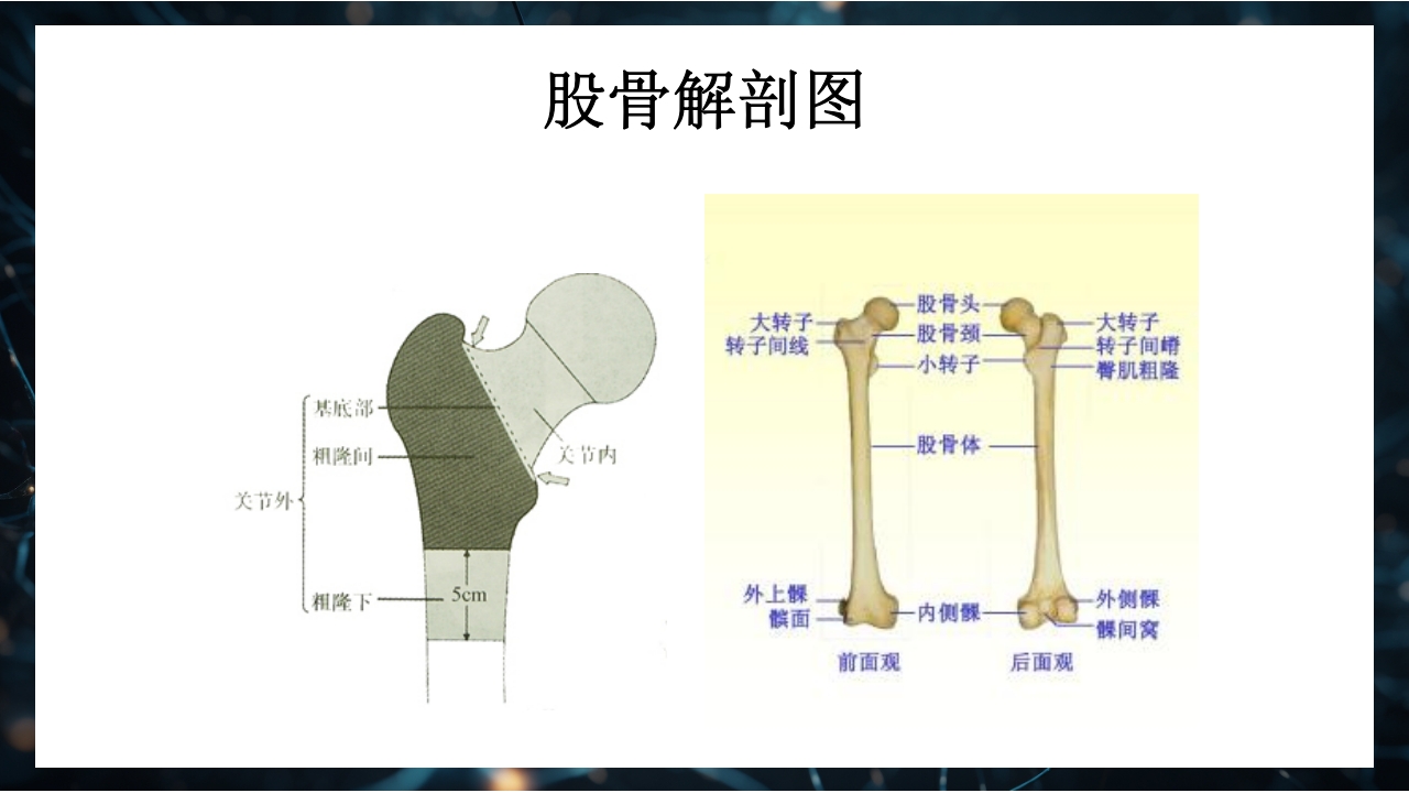 股骨粗隆间骨折护理查房PPT课件13