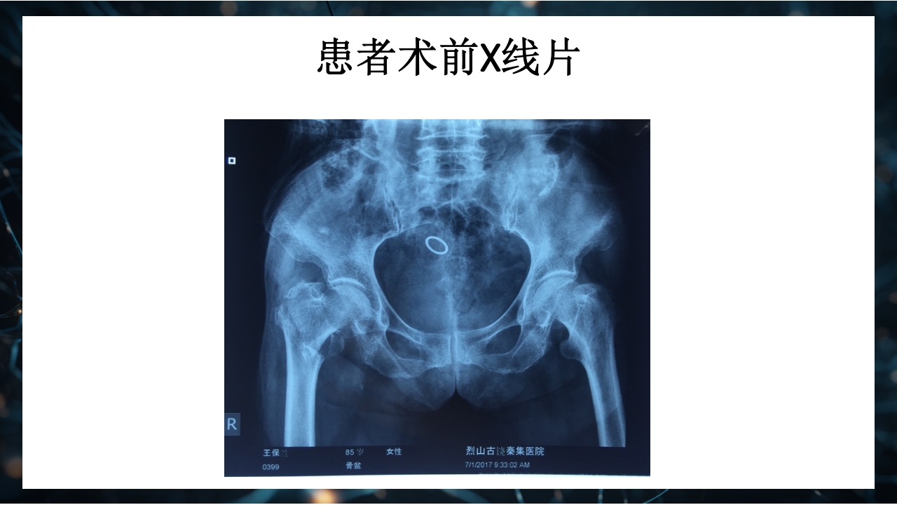 股骨粗隆间骨折护理查房PPT课件14