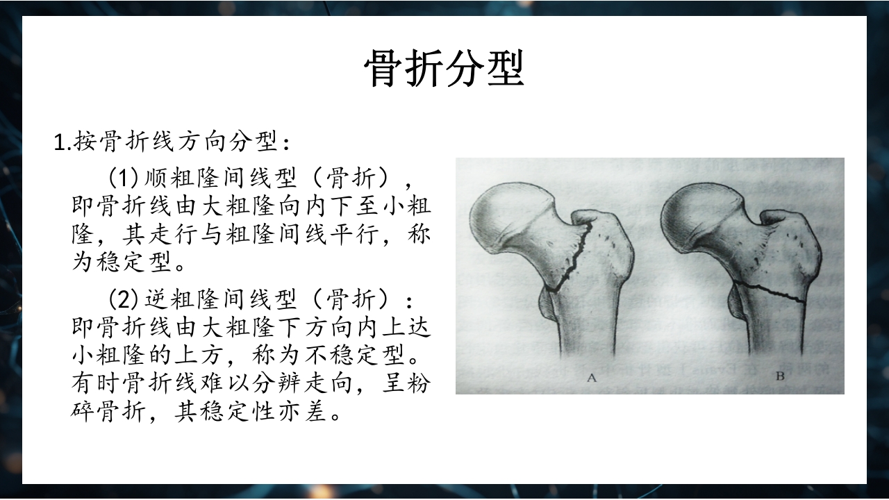 股骨粗隆间骨折护理查房PPT课件16