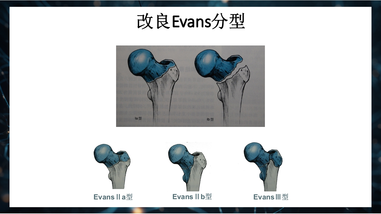 股骨粗隆间骨折护理查房PPT课件18
