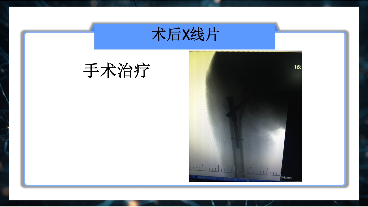 股骨粗隆间骨折护理查房PPT课件21