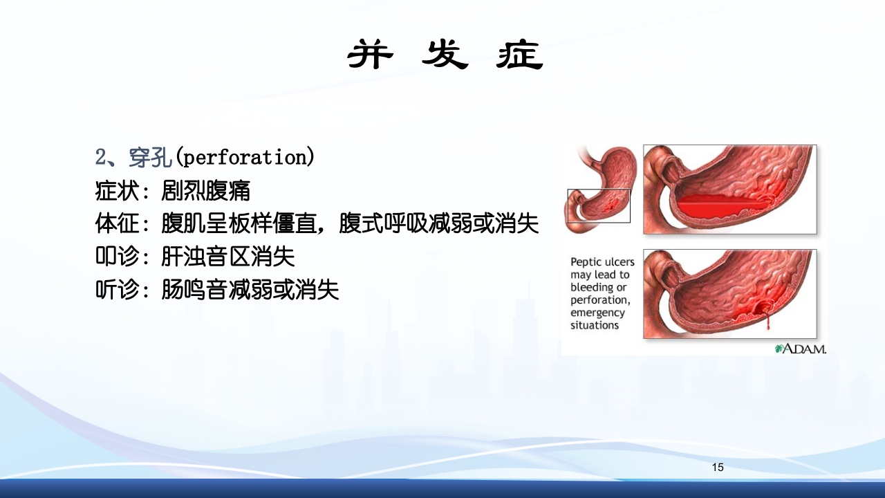 消化性溃疡的护理PPT课件15