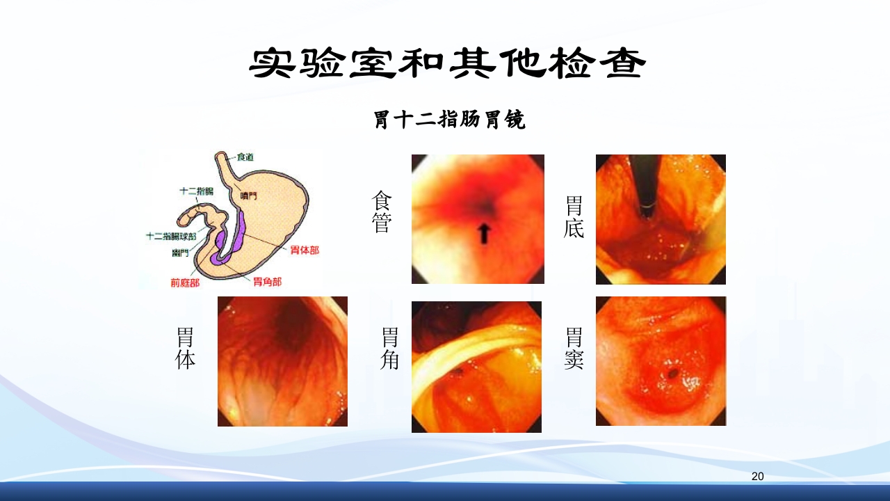 消化性溃疡的护理PPT课件20