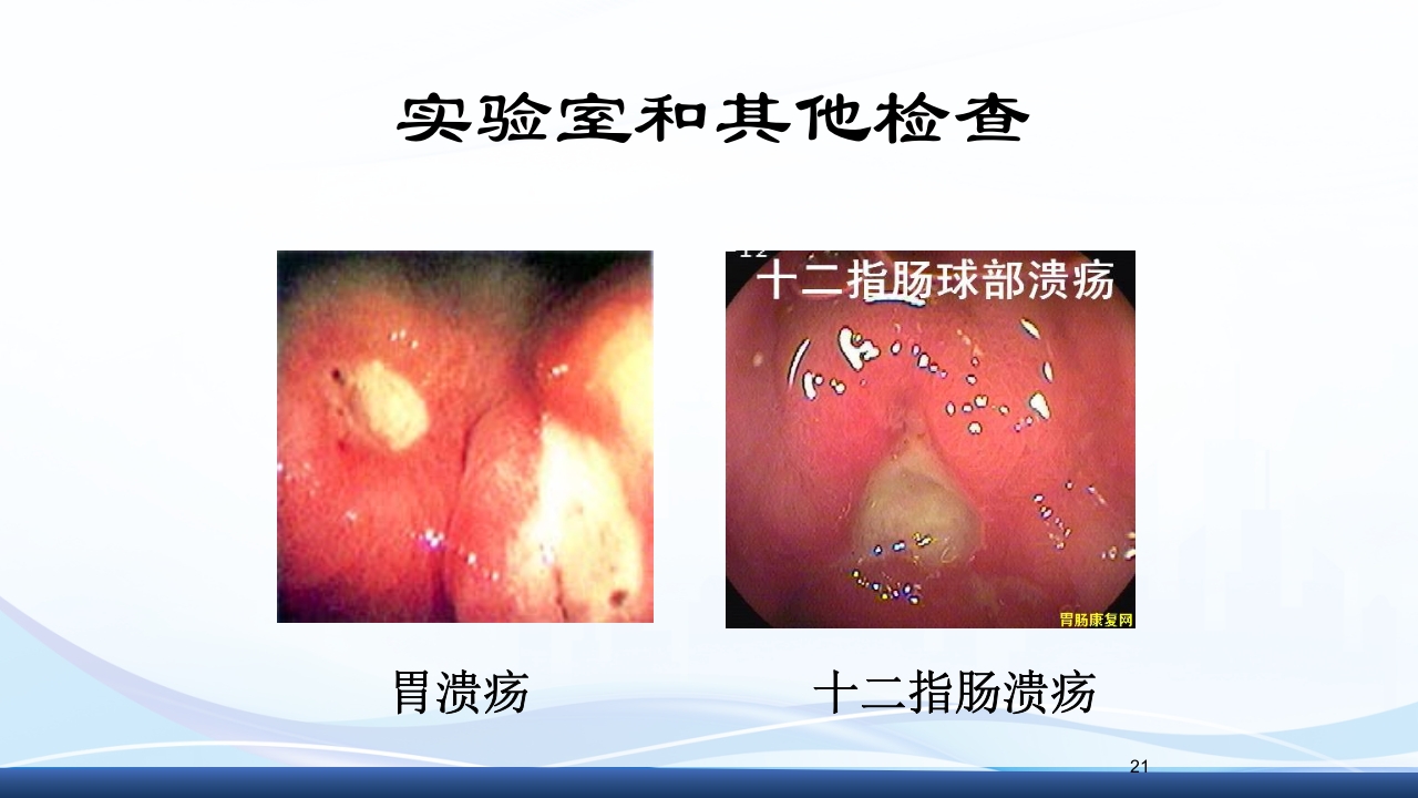 消化性溃疡的护理PPT课件21