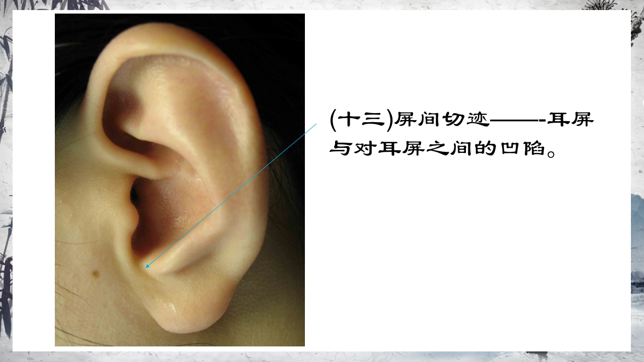 耳穴压豆治疗PPT课件21