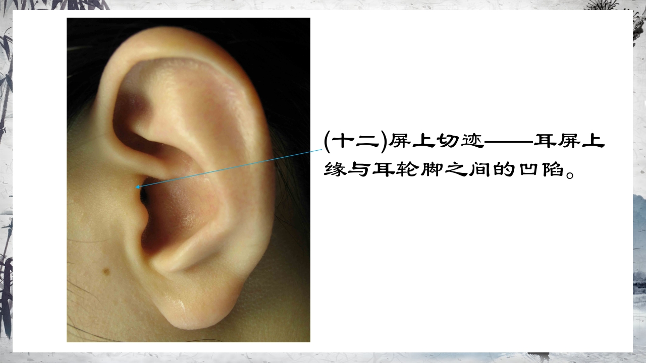 耳穴压豆治疗PPT课件23