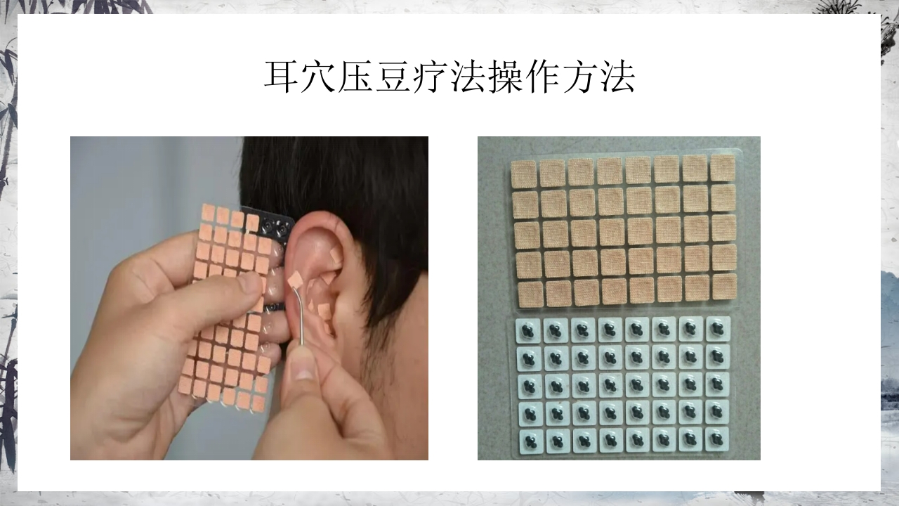 耳穴压豆治疗PPT课件44