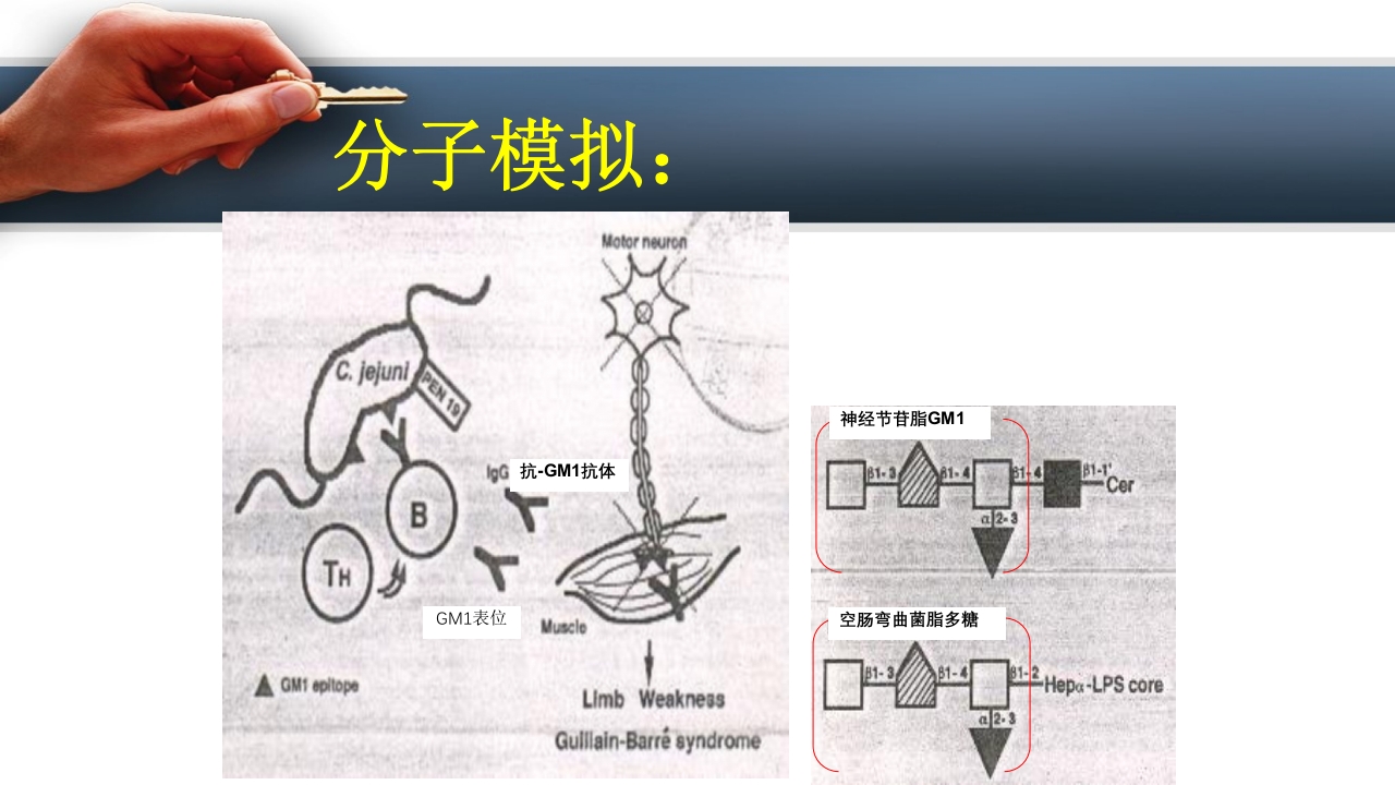 吉兰巴雷综合征PPT课件5
