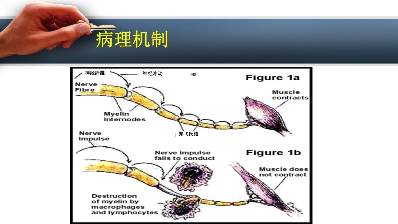 吉兰巴雷综合征PPT课件6