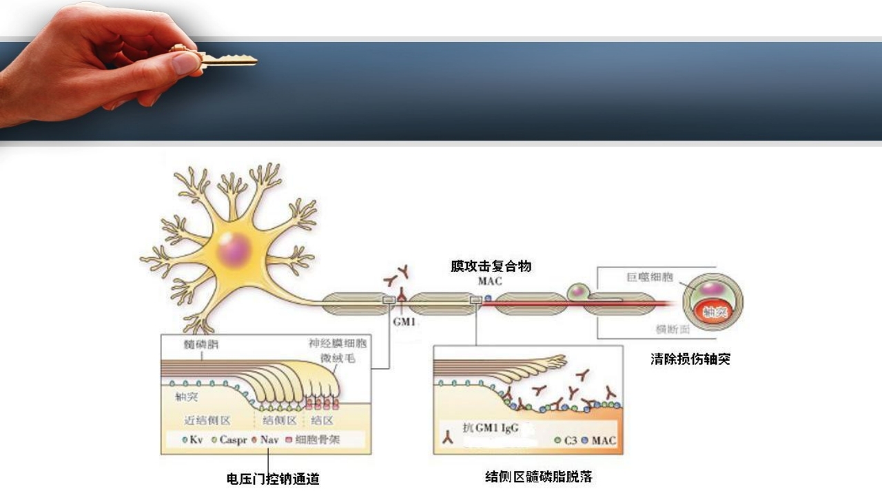 吉兰巴雷综合征PPT课件8
