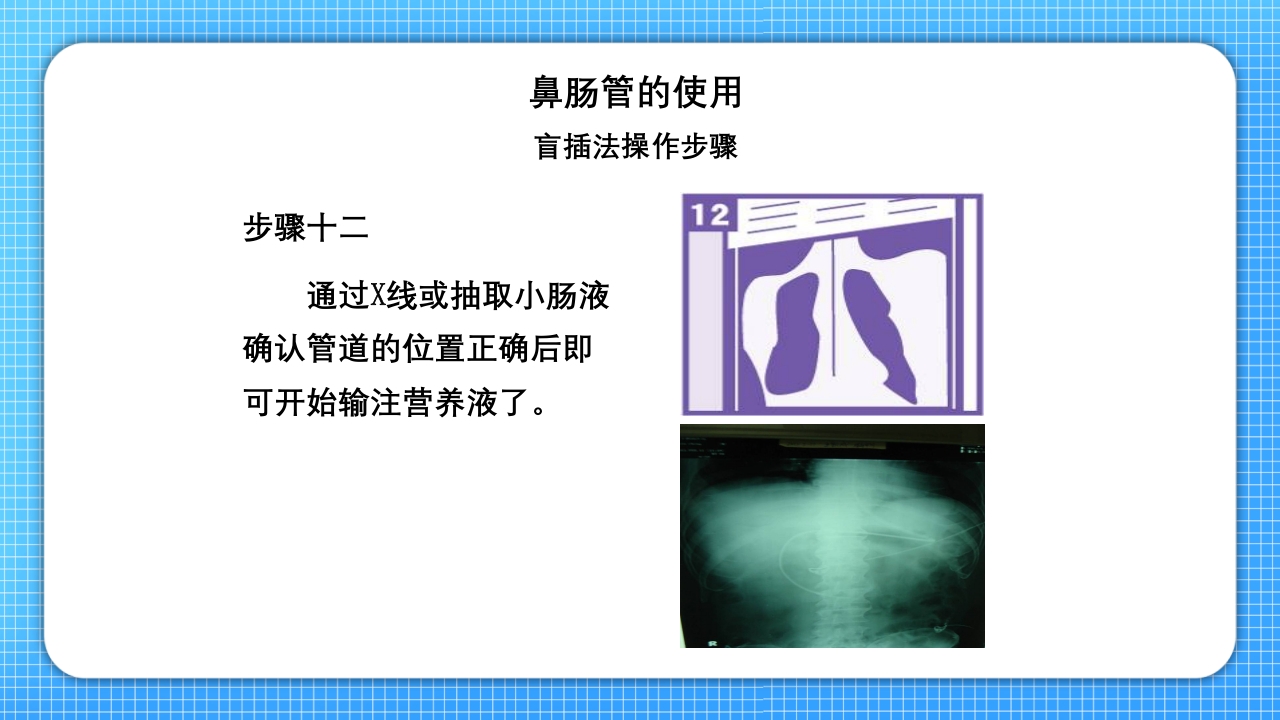 鼻肠管的护理PPT课件20