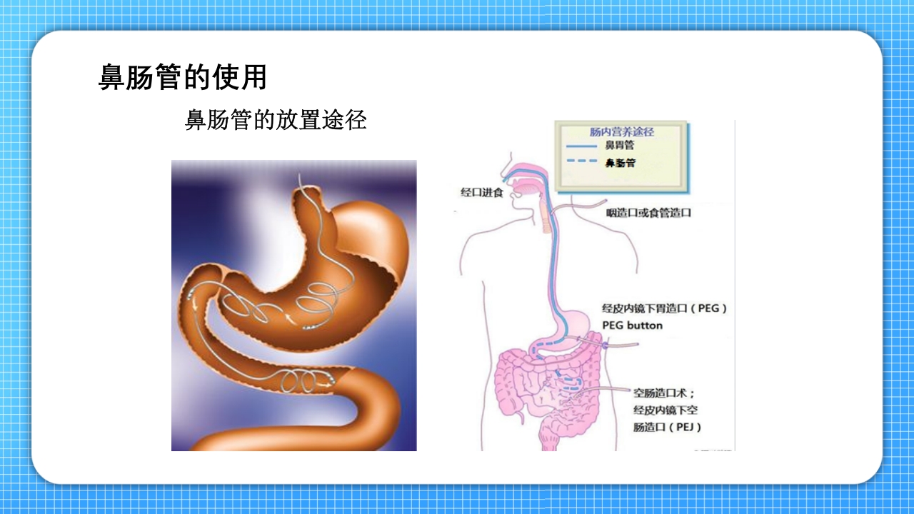 鼻肠管的护理PPT课件6