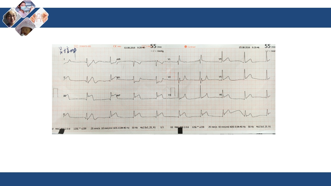 心肌梗死心源性休克ppt课件38