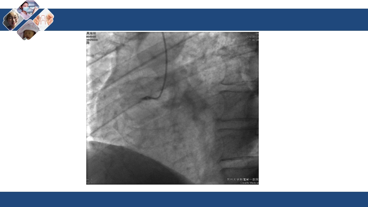 心肌梗死心源性休克ppt课件41