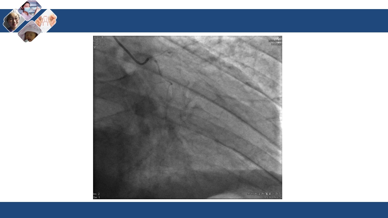心肌梗死心源性休克ppt课件42