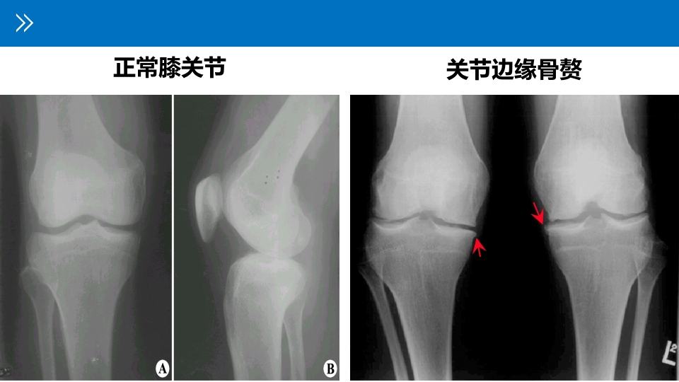 退行性膝关节病变PPT课件15
