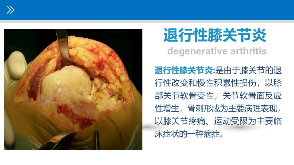 退行性膝关节病变PPT课件2