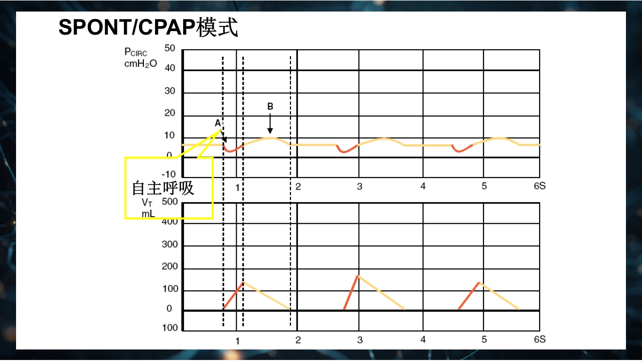 呼吸机原理介绍PPT课件56