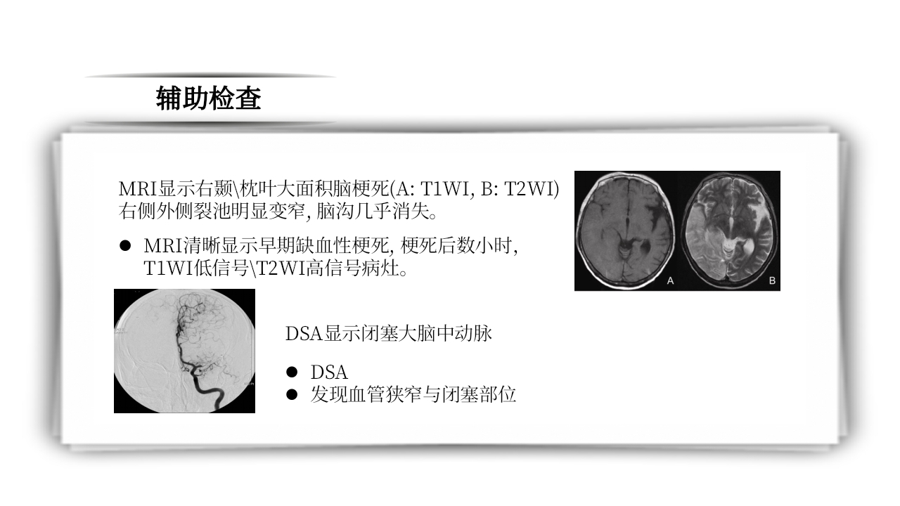脑梗死PPT课件20