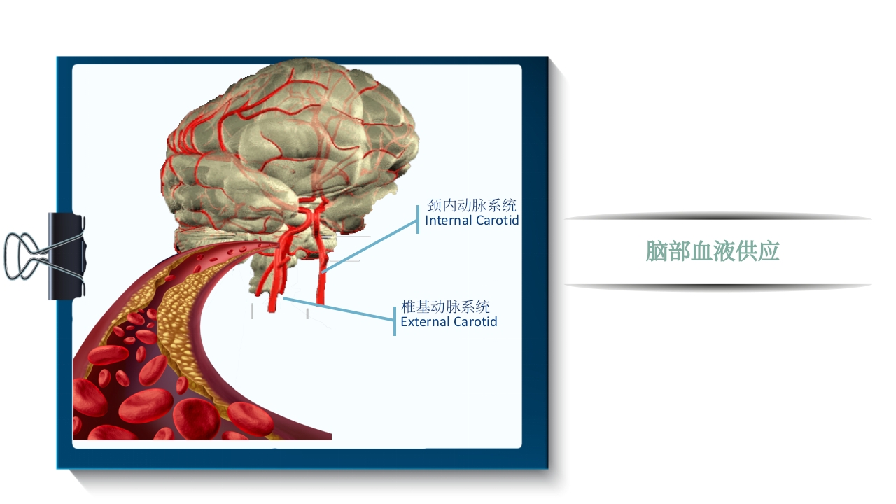 脑梗死PPT课件5
