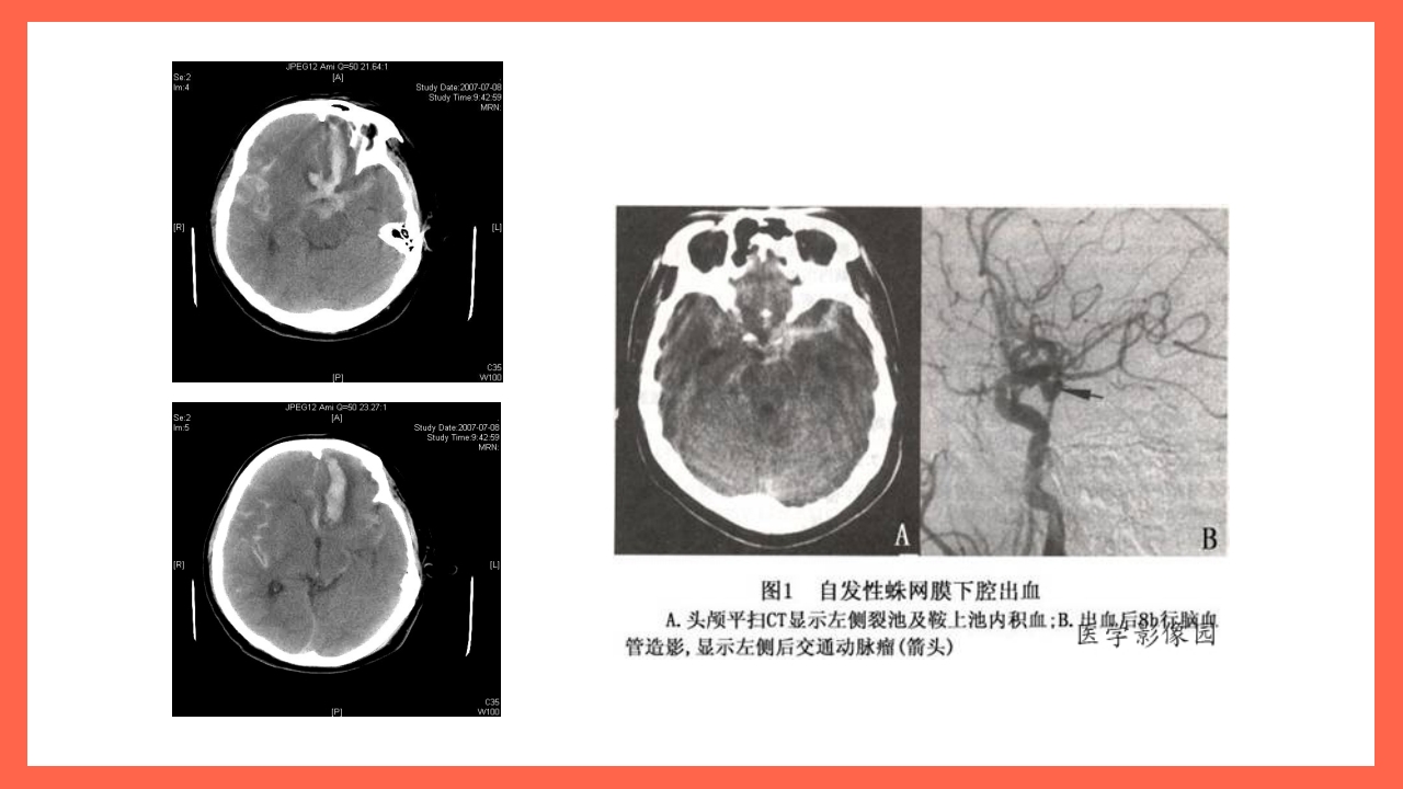 蛛网膜下腔出血的护理要点PPT课件11