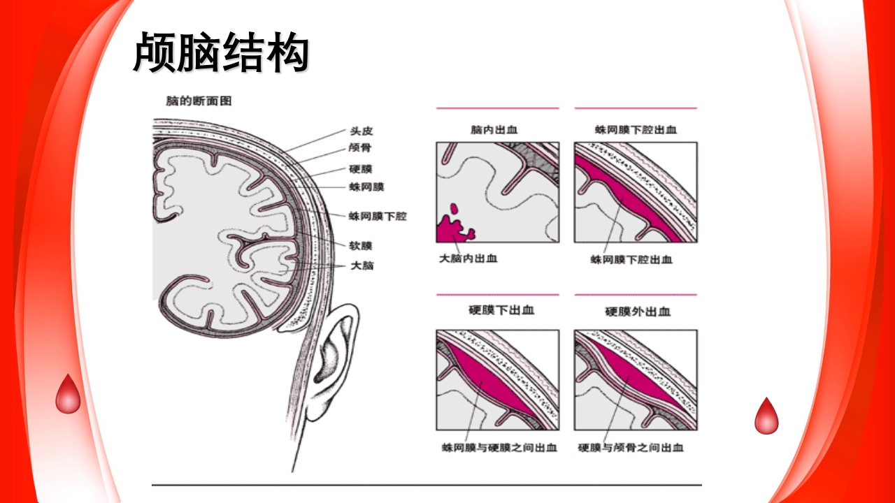 蛛网膜下腔出血的护理要点PPT课件3
