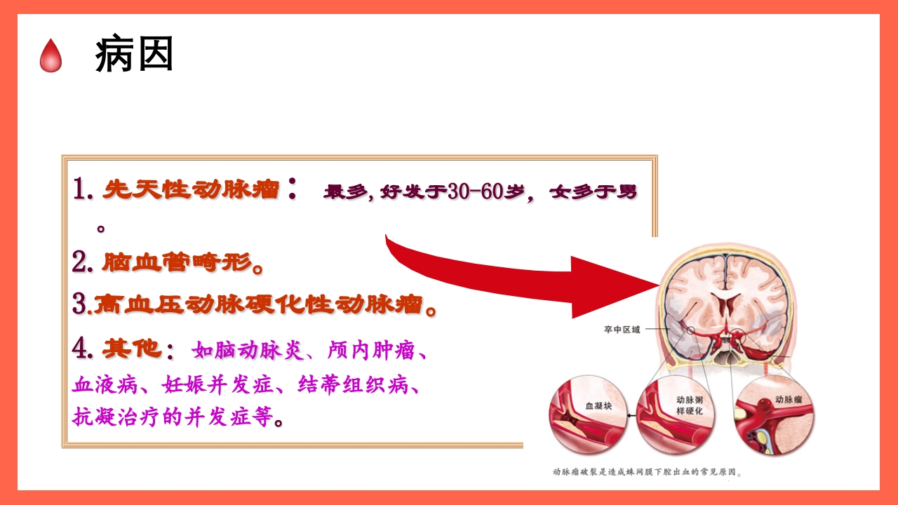 蛛网膜下腔出血的护理要点PPT课件6
