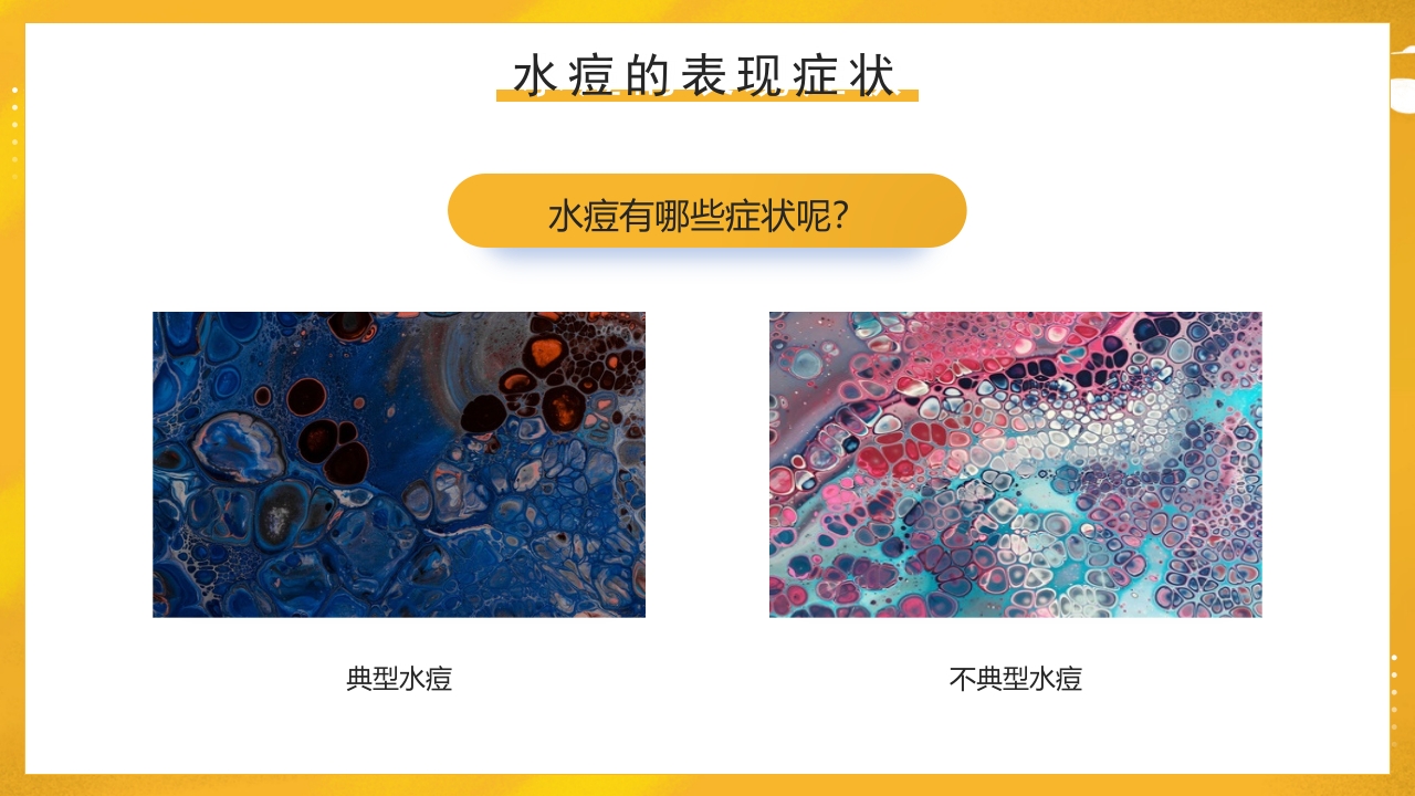 幼儿园预防水痘健康知识PPT课件12