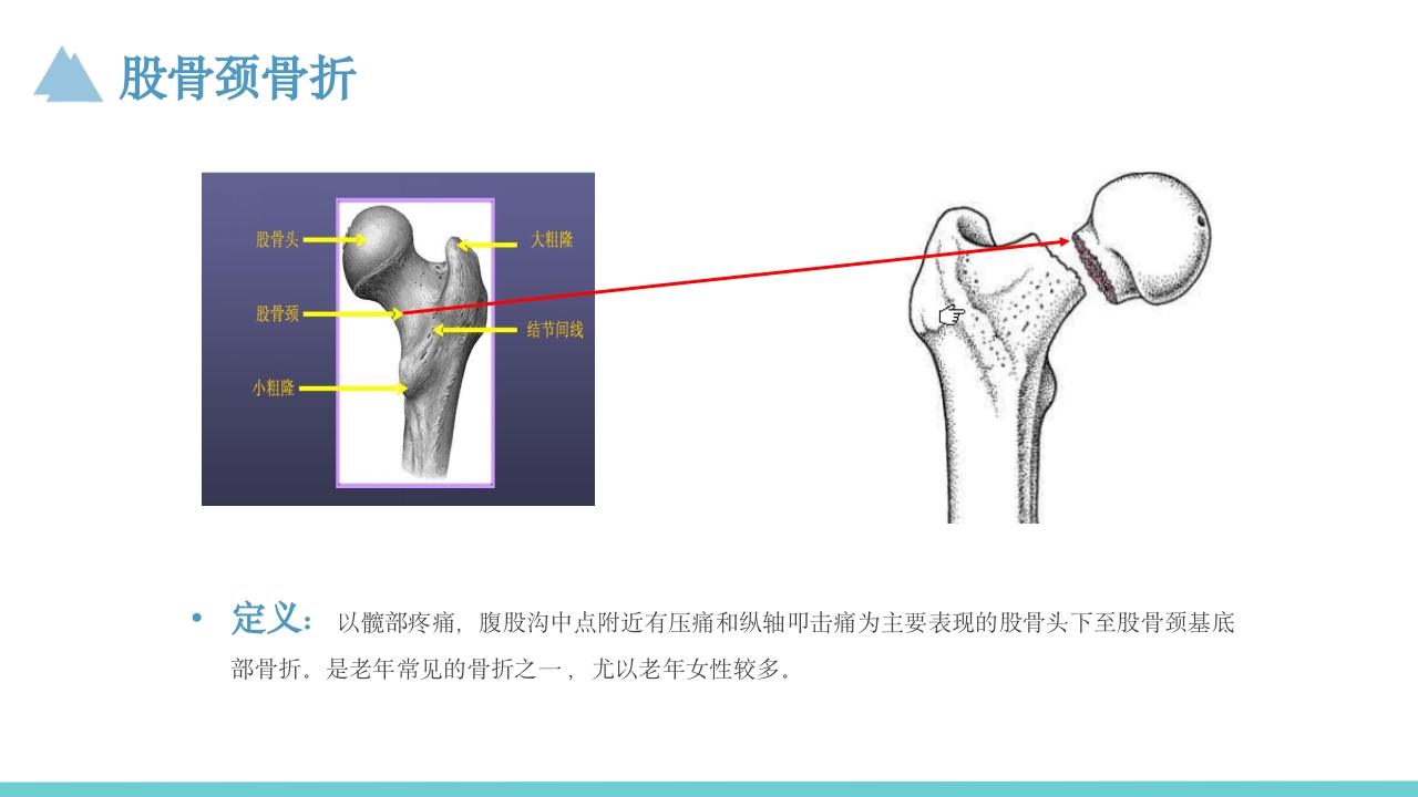 股骨颈骨折护理教学查房PPT课件5