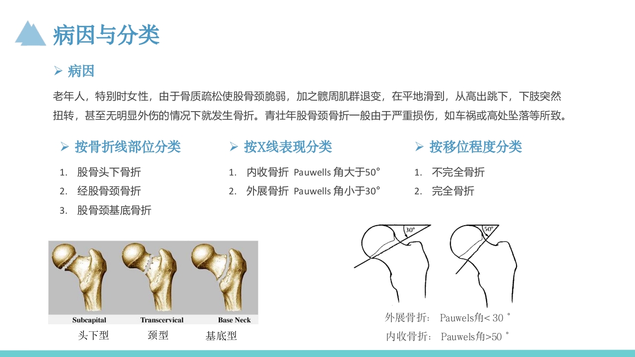 股骨颈骨折护理教学查房PPT课件6